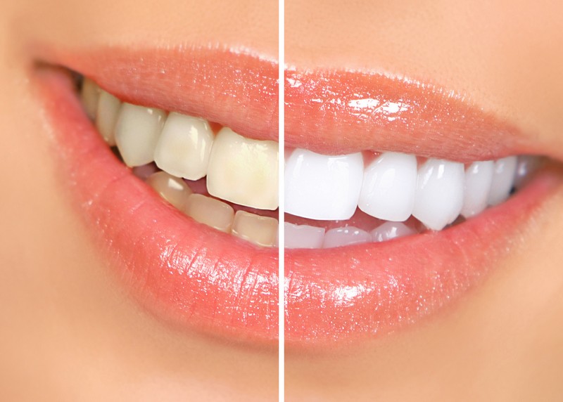 Teeth Whitening Taylors, SC 